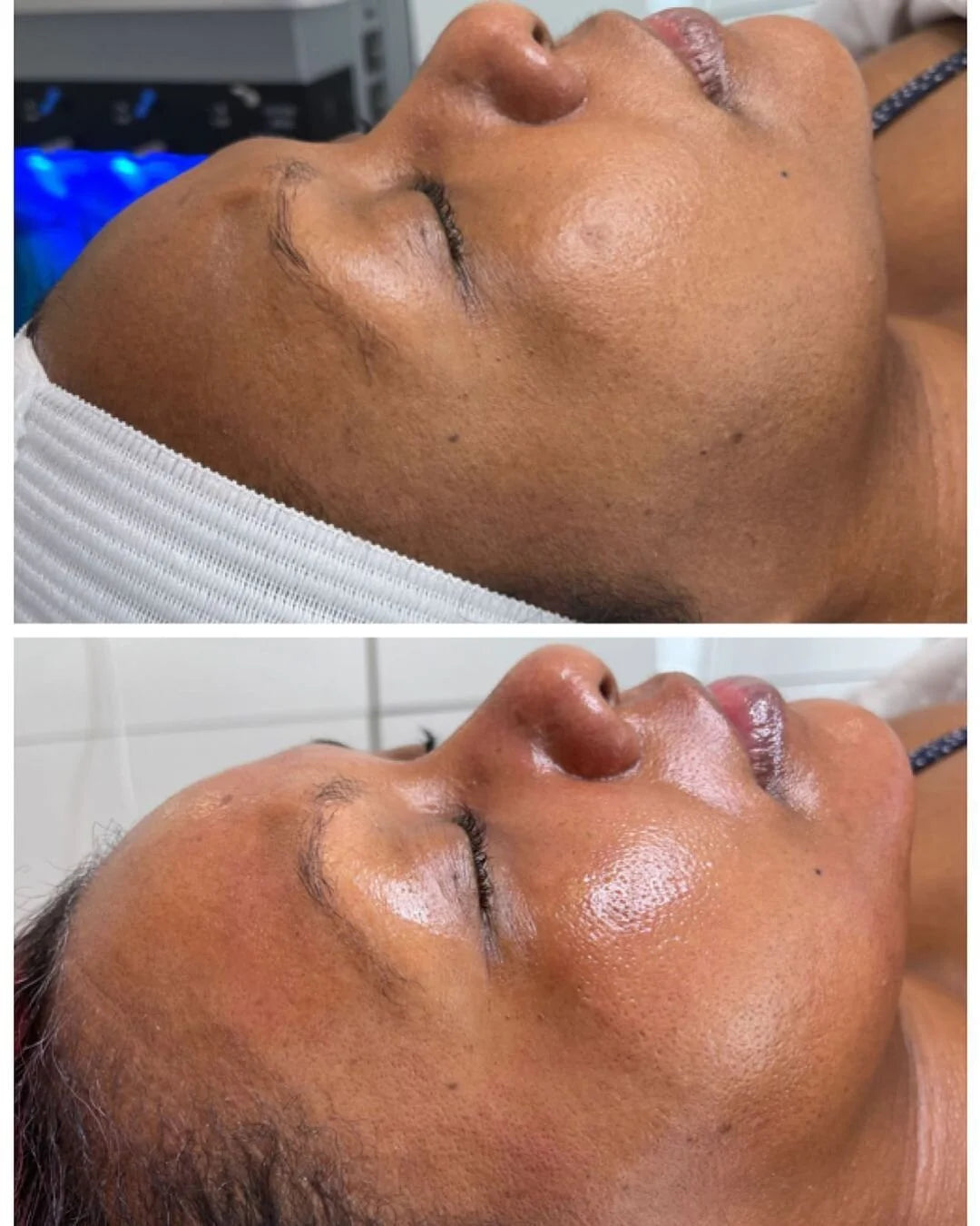 HYDRAFACIAL® BASIC